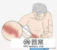 带状疱疹是怎么回事啊？怎么治疗才有效呢？