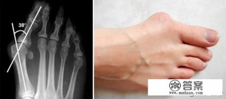 大脚骨需要手术吗？需要多少费用