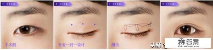 双眼皮手术哪种最好