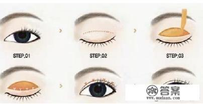 双眼皮手术哪种最好