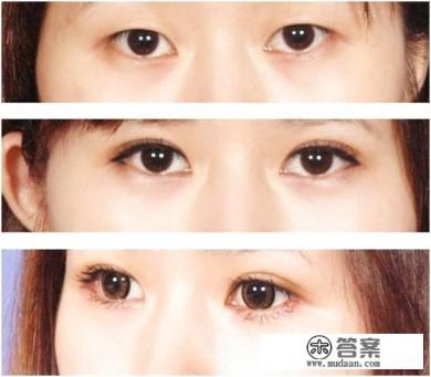 眼部整形手术要花多少钱