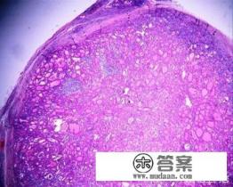 桥本氏甲状腺炎怎么治疗比较好