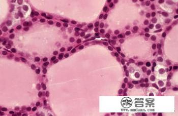 桥本氏甲状腺炎怎么治疗比较好