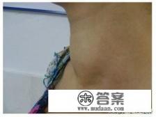 桥本氏甲状腺炎怎么治疗比较好