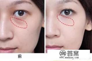 玻尿酸填充泪沟一次多少钱