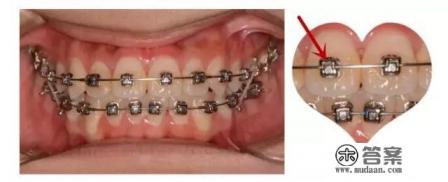 牙齿矫正需要多长时间,费用大概多少 牙齿矫正需要多长时间,费用大概多少