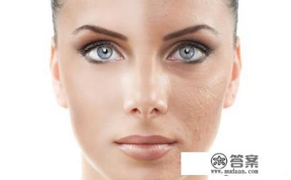 激光祛斑手术后要如何护理 激光祛斑手术后要如何护理