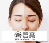 激光祛斑一次多少钱 激光祛斑一次多少钱