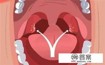 急性化脓性扁桃体炎患者是否可以吃米饭？