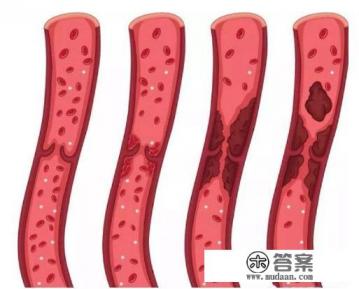 下肢深静脉血栓能治好吗 下肢深静脉血栓能治好吗