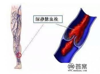 下肢深静脉血栓能治好吗 下肢深静脉血栓能治好吗