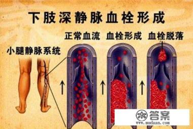 下肢深静脉血栓能治好吗 下肢深静脉血栓能治好吗